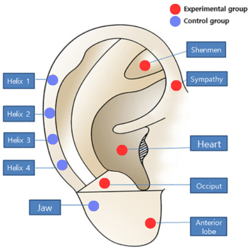 Ear auricular treatment for anxiety