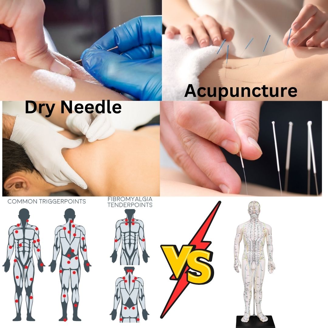 Dry Needling vs Acupuncture