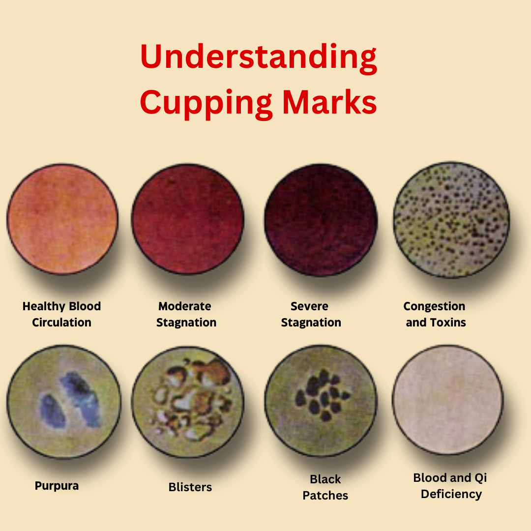 Understanding Cupping Marks