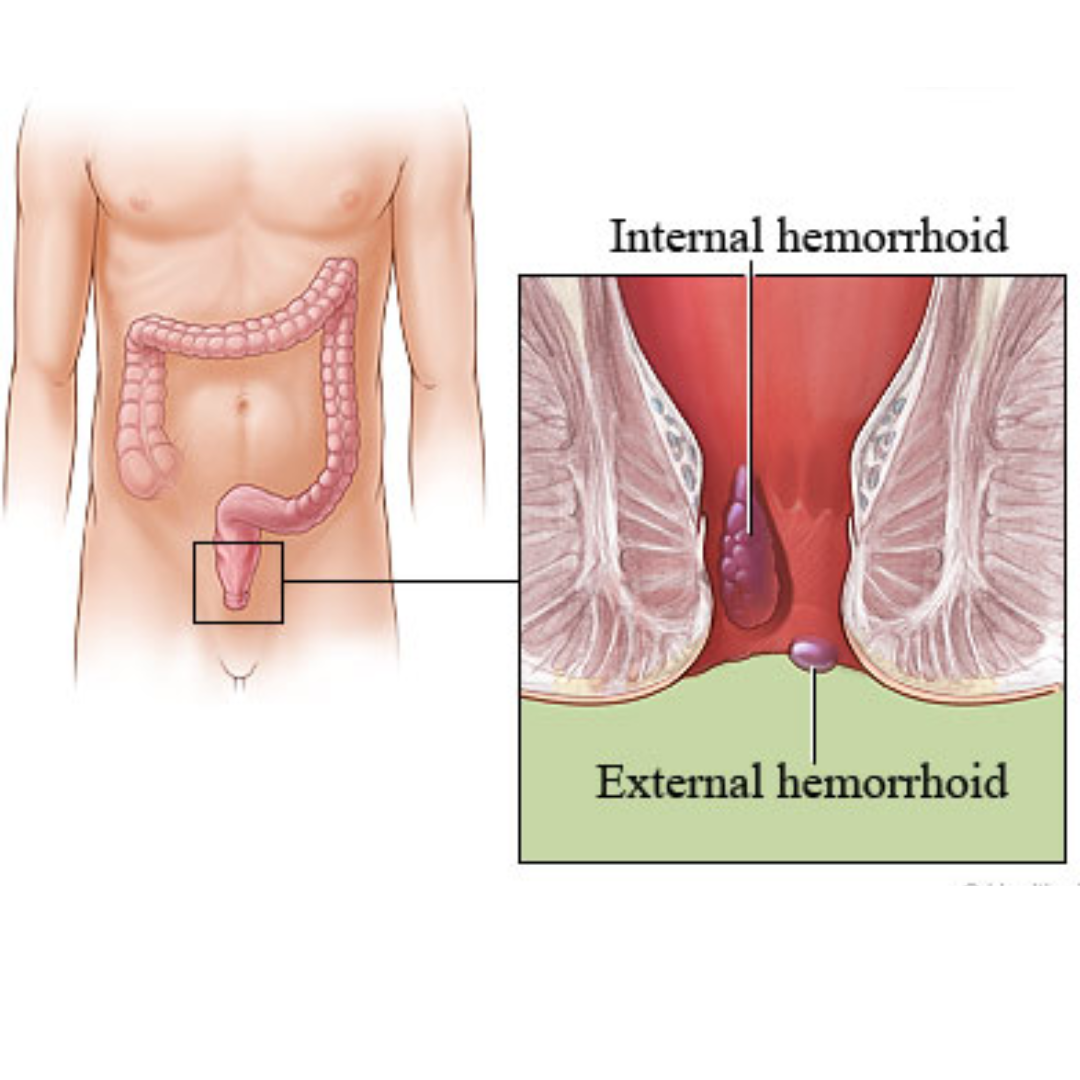 Hemorrhoids